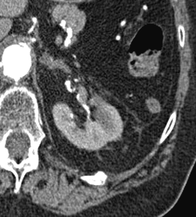 xray of a tumor